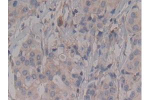 Detection of Rock2 in Human Breast cancer Tissue using Polyclonal Antibody to Rho Associated Coiled Coil Containing Protein Kinase 2 (Rock2) (ROCK2 抗体  (AA 904-1140))