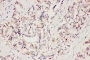 Anti-VEGF Picoband antibody,  IHC(P): Human Lung Cancer Tissue (VEGFA 抗体  (AA 27-191))