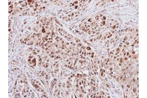 IHC-P Image Immunohistochemical analysis of paraffin-embedded A549 xenograft, using S6K2, antibody at 1:500 dilution. (RPS6KB2 抗体  (Center))