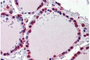 Human Thyroid (formalin-fixed, paraffin-embedded) stained with  antibody ABIN462276 followed by biotinylated secondary antibody, alkaline phosphatase-streptavidin and chromogen. (CRABP1 抗体  (AA 1-137))