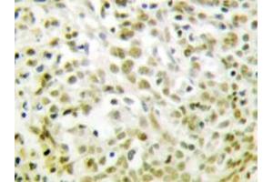 Immunohistochemistry analyzes of p53 antibody in paraffin-embedded human lung carcinoma tissue. (p53 抗体)