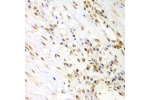Immunohistochemistry of paraffin-embedded human gastric cancer using LHX4 antibody (ABIN5975324) at dilution of 1/100 (40x lens). (LHX4 抗体)