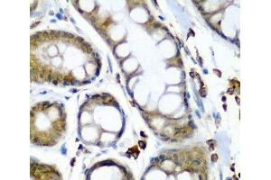 Immunohistochemistry of paraffin-embedded Human colon carcinoma using SECISBP2 Polyclonal Antibody at dilution of 1:200 (40x lens). (SECISBP2 抗体)