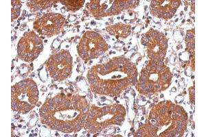 IHC-P Image Immunohistochemical analysis of paraffin-embedded human colon carcinoma, using USP8, antibody at 1:500 dilution. (USP8 抗体)