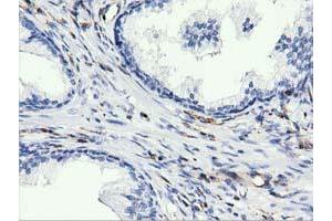 Immunohistochemical staining of paraffin-embedded Human liver tissue using anti-ARHGAP25 mouse monoclonal antibody. (ARHGAP25 抗体)