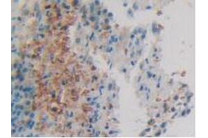 IHC-P analysis of Human Skin Cancer Tissue, with DAB staining. (Calretinin 抗体  (AA 28-248))