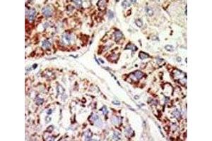IHC analysis of FFPE human hepatocarcinoma tissue stained with the EZH1 antibody (EZH1 抗体  (AA 393-422))