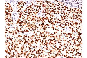 Formalin-fixed, paraffin-embedded human Breast Carcinoma stained with Progesterone Receptor Mouse Monoclonal Antibody (PR484). (Progesterone Receptor 抗体)