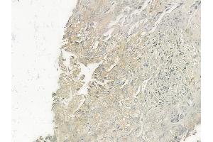 ABIN6262103 and ABIN6277371 at 1/100 staining human lung squamous cell carcinoma by IHC-P. (GRPR 抗体  (Internal Region))
