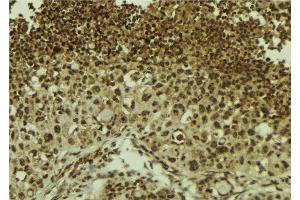 ABIN6278705 at 1/100 staining Human breast cancer tissue by IHC-P. (ZNF7 抗体  (Internal Region))