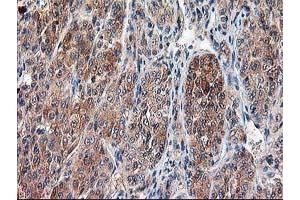 Immunohistochemical staining of paraffin-embedded Carcinoma of Human liver tissue using anti-CAPN9 mouse monoclonal antibody. (Calpain 9 抗体)