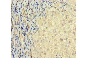 Immunohistochemistry of paraffin-embedded human liver cancer using ABIN7171548 at dilution of 1:100 (TAS2R41 抗体  (AA 205-234))