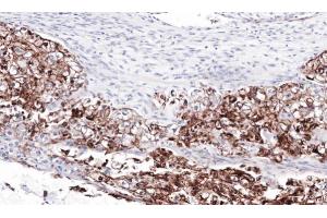 IHC-P Image Immunohistochemical analysis of paraffin-embedded human ovarian cancer, using FLRT1, antibody at 1:100 dilution. (FLRT1 抗体)