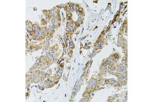 Immunohistochemistry of paraffin-embedded human liver cancer using SIRT3 antibody (ABIN5973348) at dilution of 1/100 (40x lens). (SIRT3 抗体)