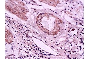 Formalin-fixed and paraffin embedded human gastric carcinoma tissue labeled with Anti-E-Selectin Polyclonal Antibody, Unconjugated (ABIN674244) at 1:200 followed by conjugation to the secondary antibody and DAB staining (Selectin E/CD62e 抗体  (AA 501-612))