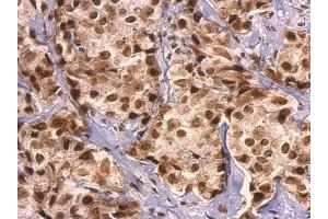 IHC-P Image GRB2 antibody detects GRB2 protein at nucleus on human breast carcinoma by immunohistochemical analysis. (GRB2 抗体  (C-Term))