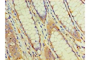 Immunohistochemistry of paraffin-embedded human colon cancer using ABIN7162957 at dilution of 1:100 (EHHADH 抗体  (AA 1-723))