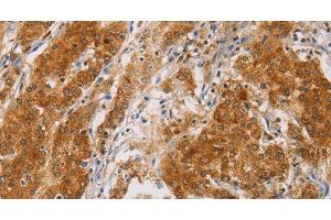 Immunohistochemistry of paraffin-embedded Human gasrtic cancer tissue using CENPE Polyclonal Antibody at dilution 1:50 (CENPE 抗体)