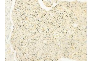 ABIN6260535 and ABIN6279822 at 1/100 staining human esophageal carcinoma by IHC-P. (CCL13 抗体  (Internal Region))