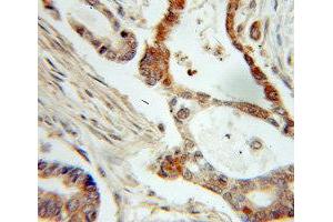 Immunohistochemistry of paraffin-embedded Pancreas cancer using NME1 antibody. (NME1 抗体  (C-Term))