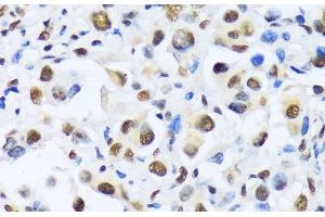 Immunohistochemistry of paraffin-embedded Human lung cancer using OTP Polyclonal Antibody at dilution of 1:100 (40x lens). (OTP 抗体)