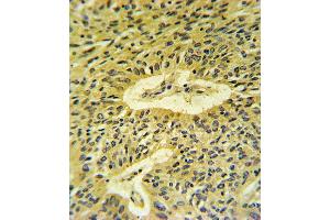 Smad7 Antibody (Center) (ABIN652239 and ABIN2840995) IHC analysis in formalin fixed and paraffin embedded lung carcinoma followed by peroxidase conjugation of the secondary antibody and DAB staining. (SMAD7 抗体  (AA 195-224))