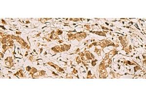Immunohistochemistry of paraffin-embedded Human gastric cancer tissue using ZMAT4 Polyclonal Antibody at dilution of 1:65(x200) (ZMAT4 抗体)
