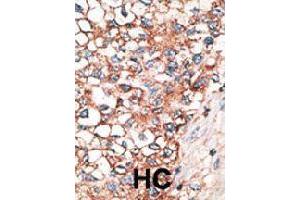 Formalin-fixed and paraffin-embedded human hepatocellular carcinoma tissue reacted with GJA9 polyclonal antibody  , which was peroxidase-conjugated to the secondary antibody, followed by AEC staining. (GJA9 抗体  (C-Term))