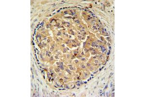SRD5A3 Antibody (C-term) (ABIN651469 and ABIN2840258) IHC analysis in formalin fixed and paraffin embedded human prostate carcinoma followed by peroxidase conjugation of the secondary antibody and DAB staining. (SRD5A3 抗体  (C-Term))
