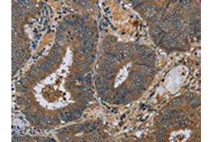 The image on the left is immunohistochemistry of paraffin-embedded Human colon cancer tissue using ABIN7130524(PAEP Antibody) at dilution 1/60, on the right is treated with fusion protein. (PAEP 抗体)