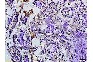 Formalin-fixed and paraffin embedded human colon carcinoma labeled with Rabbit Anti-MMP-7 Polyclonal Antibody, Unconjugated (ABIN668451) at 1:200 followed by conjugation to the secondary antibody and DAB staining. (MMP7 抗体  (AA 151-250))