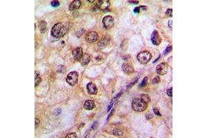 Immunohistochemical analysis of AKT (pY474) staining in human breast cancer formalin fixed paraffin embedded tissue section.