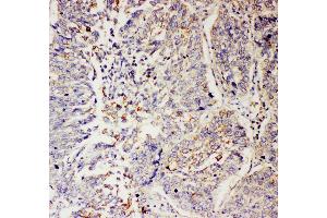 Anti-SLC9A2 antibody, IHC(P) IHC(P): Human Lung Cancer Tissue (SLC9A2 抗体  (C-Term))