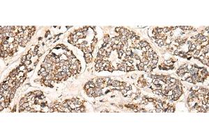 Immunohistochemistry of paraffin-embedded Human esophagus cancer tissue using C1S Polyclonal Antibody at dilution of 1:55(x200) (C1S 抗体)