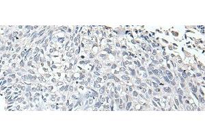 Immunohistochemistry of paraffin-embedded Human lung cancer tissue using RERG Polyclonal Antibody at dilution of 1:65(x200) (RERG 抗体)