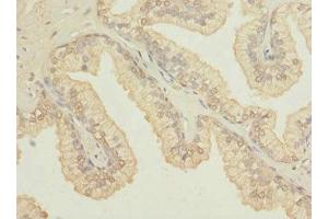Immunohistochemistry of paraffin-embedded human prostate cancer using ABIN7164612 at dilution of 1:100