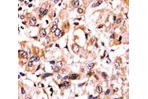 IHC analysis of FFPE human hepatocarcinoma tissue stained with the phospho-Wee1 antibody. (WEE1 抗体  (pSer123))
