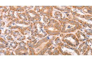 Immunohistochemistry of paraffin-embedded Human thyroid cancer tissue using TRPV4 Polyclonal Antibody at dilution 1:40 (TRPV4 抗体)