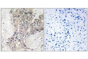Immunohistochemistry analysis of paraffin-embedded human liver carcinoma tissue using B3GALTL antibody. (B3GALTL 抗体  (C-Term))