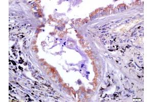 Formalin-fixed and paraffin embedded human lung carcinoma labeled with Anti-LAG-3/CD223 Polyclonal Antibody, Unconjugated (ABIN748508) at 1:200 followed by conjugation to the secondary antibody and DAB staining (LAG3 抗体  (AA 201-300))
