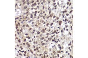 Immunohistochemistry of paraffin-embedded human lung cancer using CHEK2 antibody. (CHEK2 抗体  (AA 1-220))