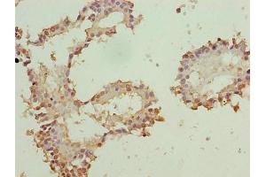 Immunohistochemistry of paraffin-embedded human breast cancer using ABIN7176136 at dilution of 1:100