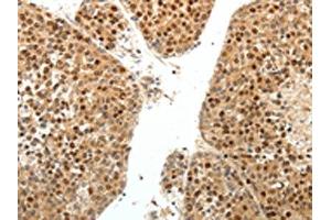 The image on the left is immunohistochemistry of paraffin-embedded Human liver cancer tissue using ABIN7131160(SPATA2L Antibody) at dilution 1/30, on the right is treated with fusion protein. (SPATA2L 抗体)