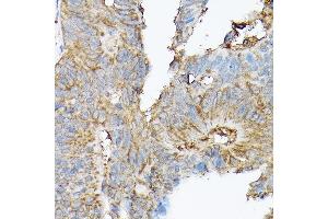 Immunohistochemistry of paraffin-embedded human colon carcinoma using SLC8 Rabbit pAb (ABIN6132664, ABIN6148050, ABIN6148052 and ABIN6221228) at dilution of 1:100 (40x lens). (SLC8A1 抗体  (AA 250-520))