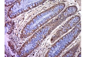 Formalin-fixed and paraffin embedded human colon cancer labeled with BTN2A1 Polyclonal Antibody, Unconjugated (bs-20473R) at 1:200, followed by conjugation to the secondary antibody and DAB staining (BTN2A1 抗体  (AA 101-200))