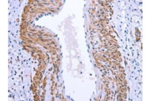 The image on the left is immunohistochemistry of paraffin-embedded Human cervical cancer tissue using ABIN7190847(GPR171 Antibody) at dilution 1/25, on the right is treated with synthetic peptide. (GPR171 抗体)
