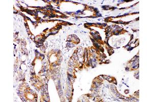 Anti-DCC antibody, IHC(P) IHC(P): Human Intestinal Cancer Tissue (DCC 抗体  (N-Term))