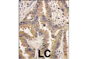 Formalin-fixed and paraffin-embedded human lung carcinoma tissue reacted with Bad antibody (Center), which was peroxidase-conjugated to the secondary antibody, followed by DAB staining. (BAD 抗体  (AA 53-81))
