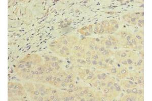 Immunohistochemistry of paraffin-embedded human liver cancer using ABIN7168643 at dilution of 1:100