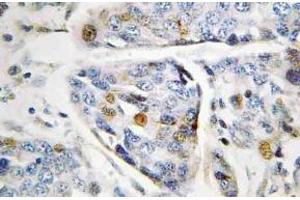 Immunohistochemistry (IHC) analyzes of Lamin A antibody in paraffin-embedded human breast carcinoma tissue. (Lamin A/C 抗体)